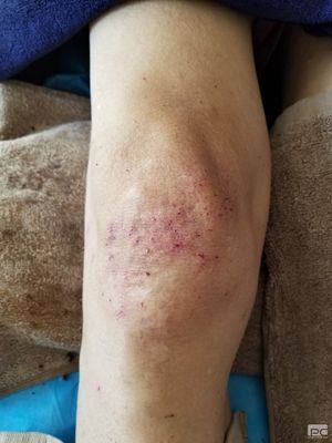膝盖积液中医怎么治疗