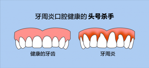 牙周炎早期怎么治疗