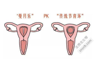 取环后是不是很难怀孕