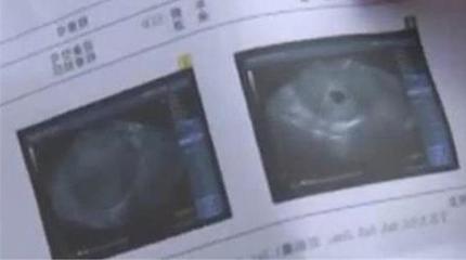 怀孕四十五天有什么反应