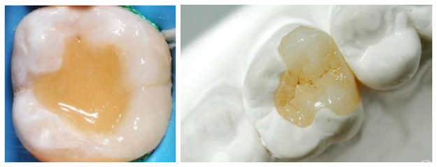 门牙树脂补牙结实吗