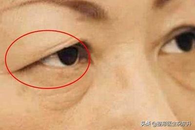 下眼皮长脂肪粒怎么办