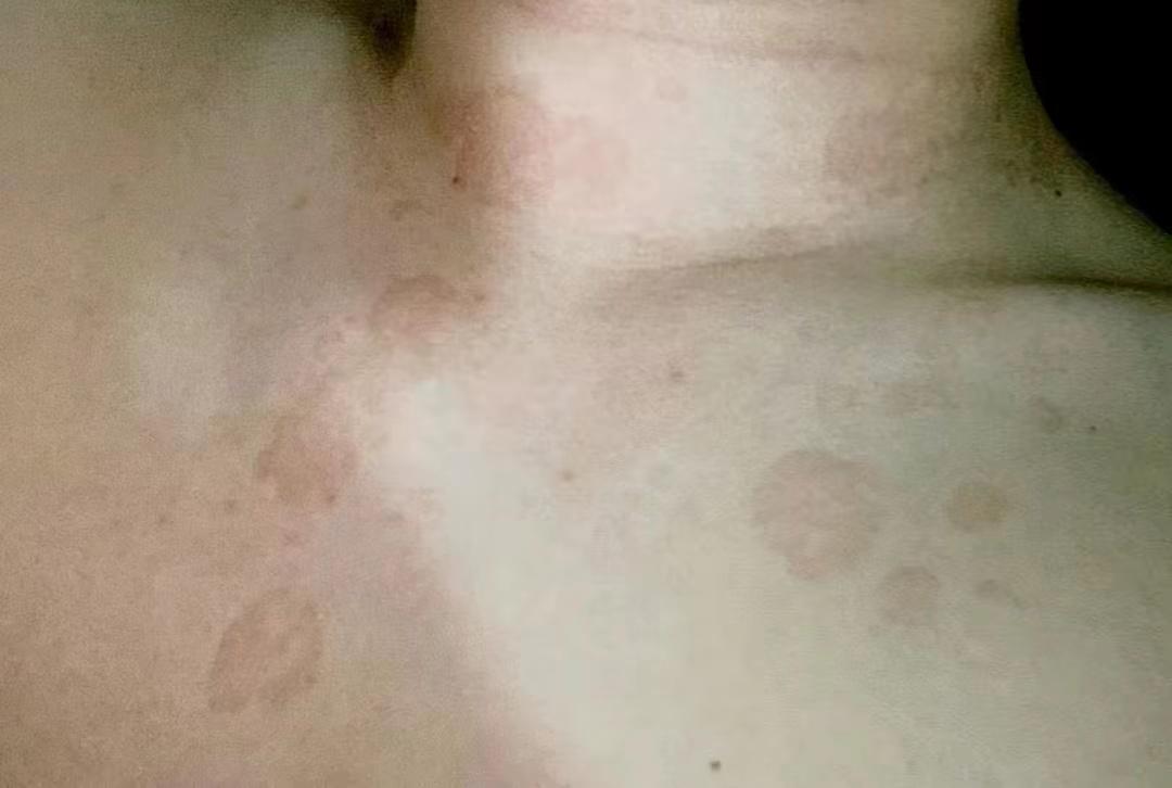 汗斑怎么治疗断根