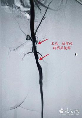 下肢动脉硬化旋切手术多少钱