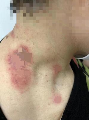 人体身上发痒怎么办