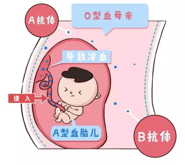 如何知道胎儿血型