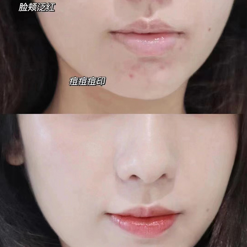 痘痘一般是什么颜色的遮瑕