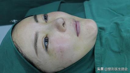 分体式隆鼻