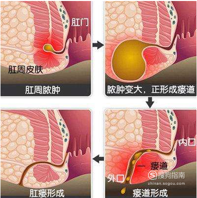 怎么治疗肛裂