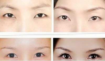 双眼皮埋线处长痘痘