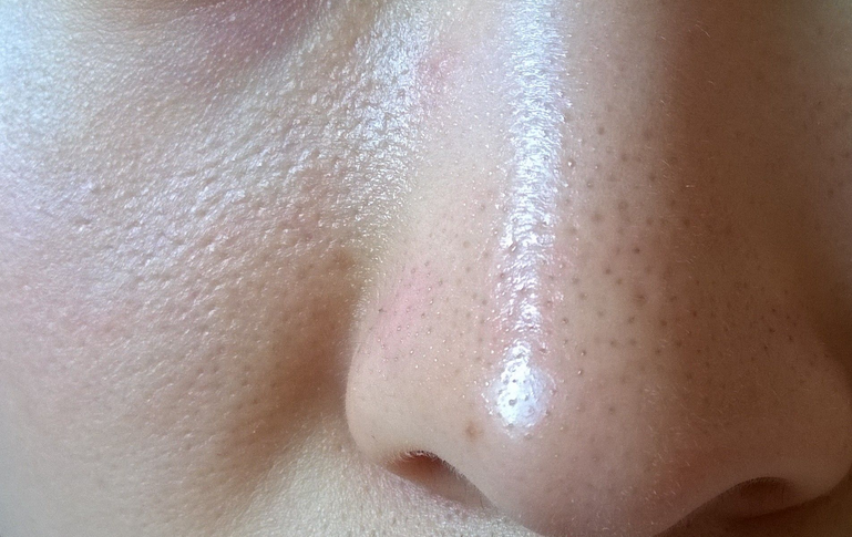 脸颊两侧毛孔越来越大