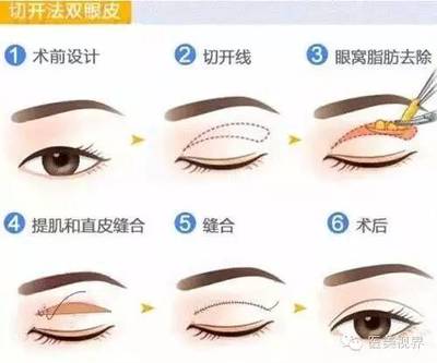 切开法双眼皮好不好