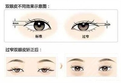 压 双眼皮