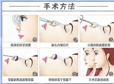 假体隆鼻恢复过程