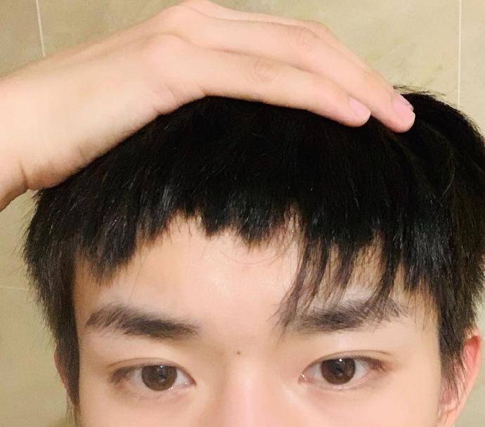 双下巴长痘痘什么原因
