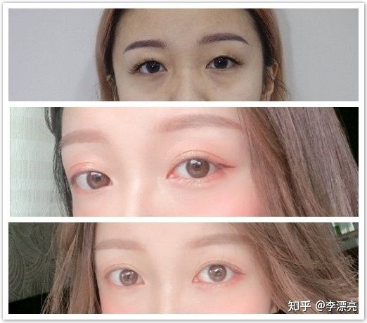 如何有双眼皮