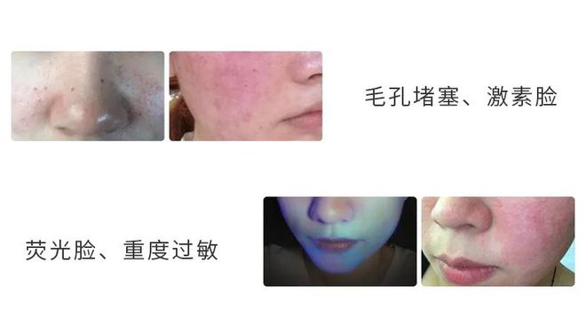 脸上有痘痘敷冰面膜