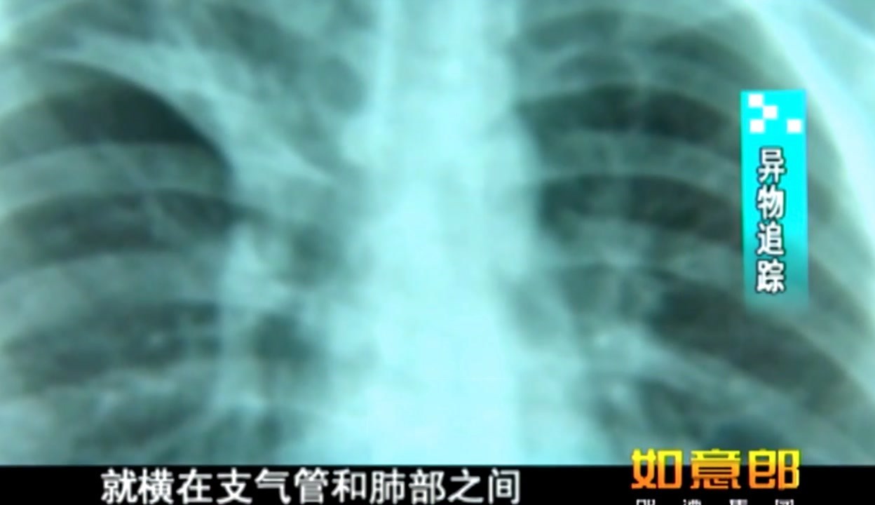 肺吐血是怎么回事