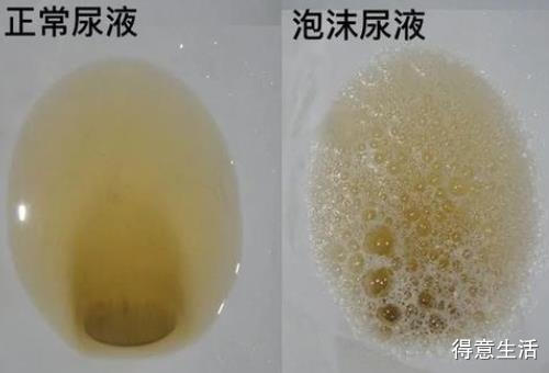 小便混沌是怎么回事