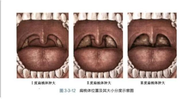 怎么治疗扁桃体肥大