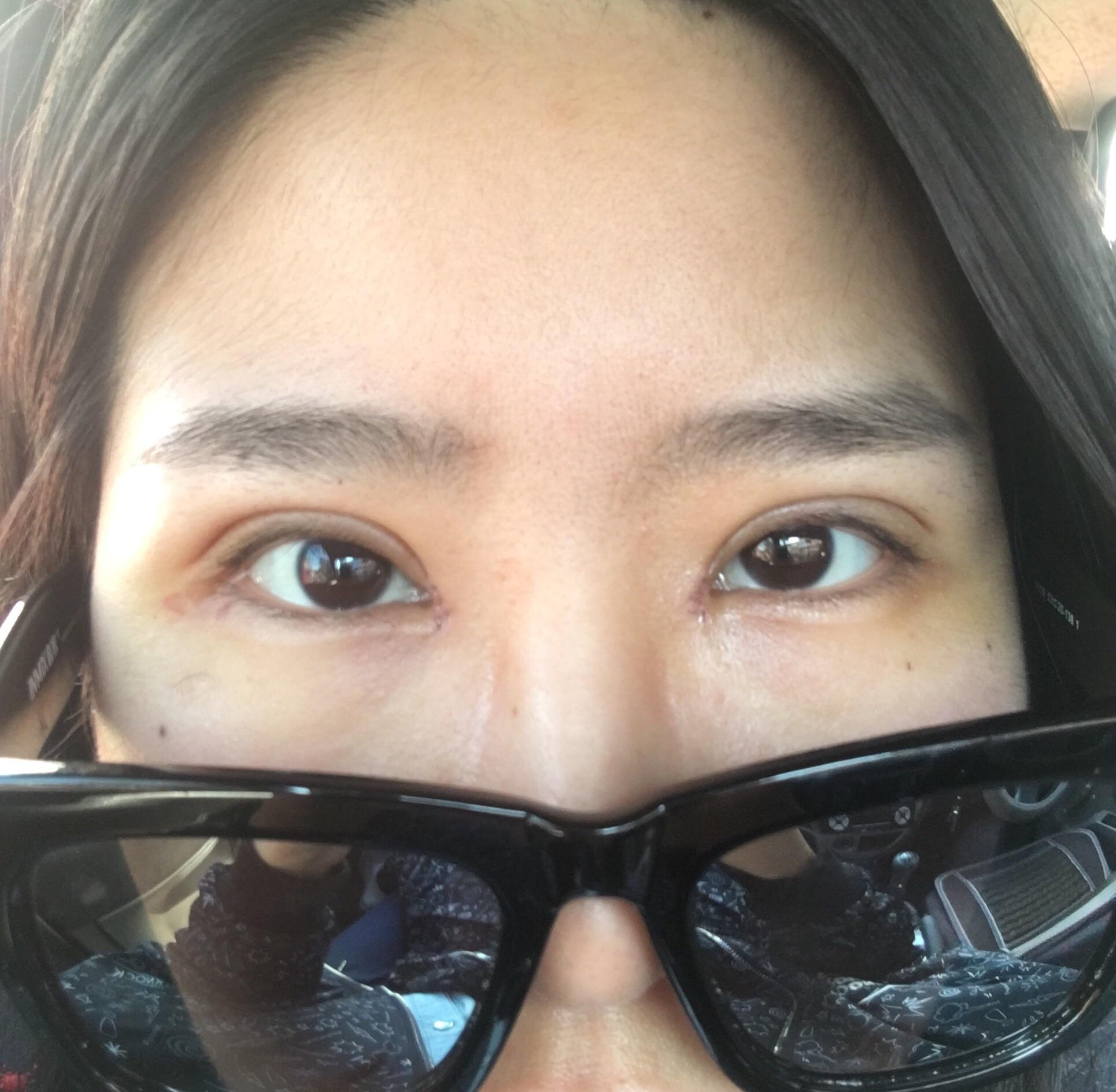 割双眼皮失败是什么样子的?