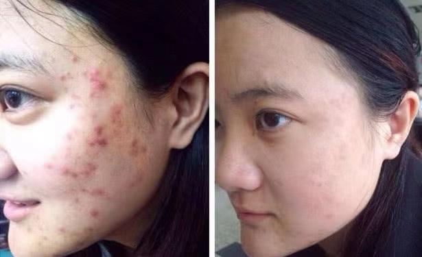 施尔美痘痘怎么消除