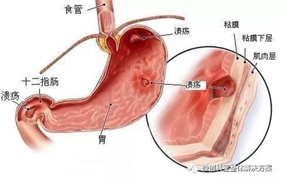 胃粘连怎么治疗方法