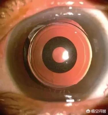 白内障手术换晶体后眼睛还会近视吗?