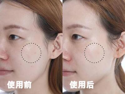 脸上有痘痘适合什么精华