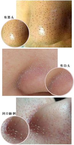 粉刺挤掉好还是不挤好