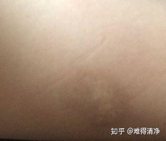 烫伤怎样不留疤痕