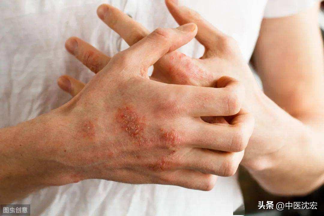 痘痘结痂可以珍珠粉