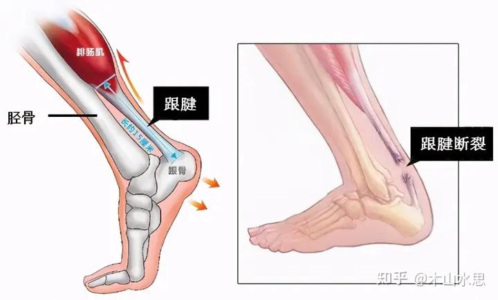 人尾巴尖骨头断了一点怎么办