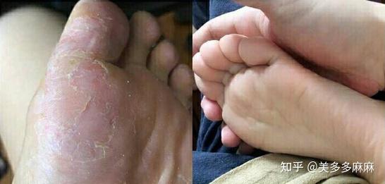 脚麻麻的是怎么回事