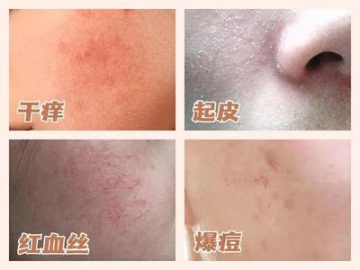 痘痘泛红是怎麽回事