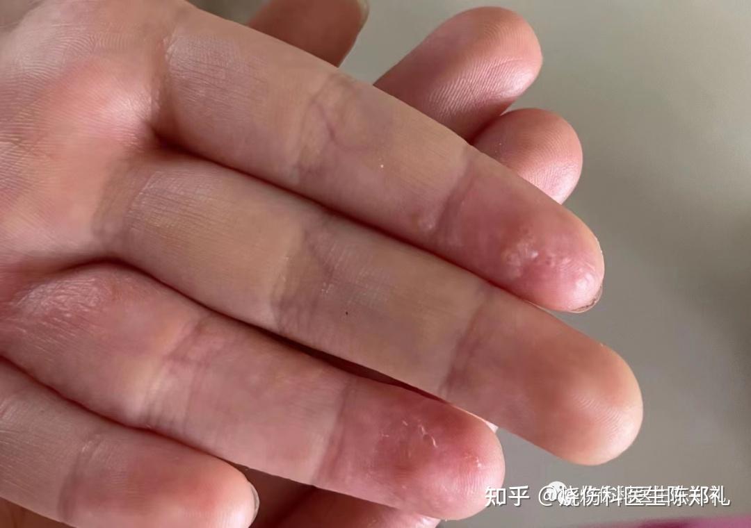孕妇汗疱疹怎么治疗